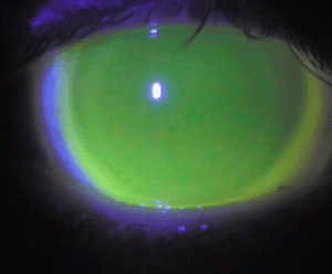 Degeneración Marginal Pelúcida y lentes esclerales